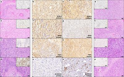 Glioblastoma Relapses Show Increased Markers of Vulnerability to Ferroptosis